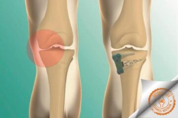 Yüksek Tibial Osteotomi