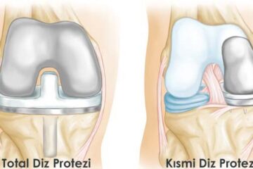 Diz Protezi